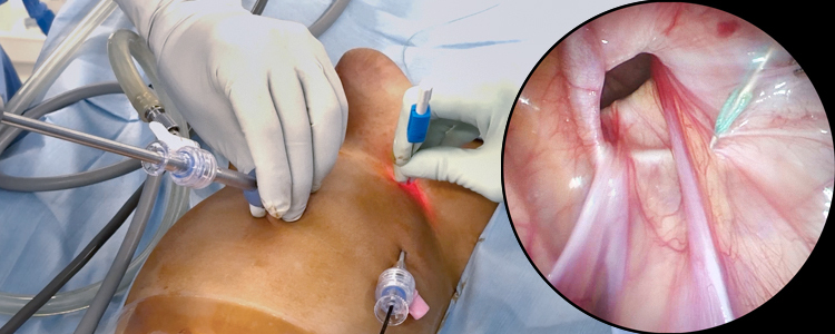 Laparoscopic Percutaneous Extraperitoneal Closure (LPEC) for an